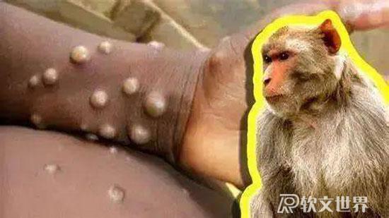 猴痘病毒中國有嗎？感染會出現(xiàn)什么癥狀？